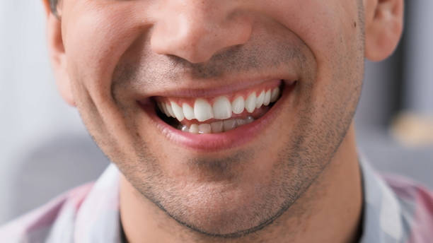 Teeth Cleaning